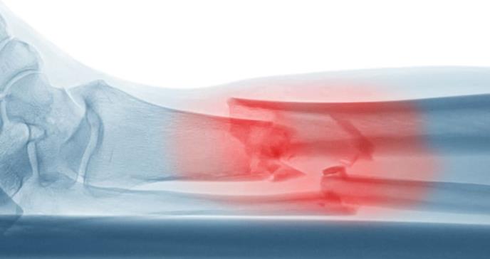 Identifican 15 variantes genéticas relacionadas con las fracturas osteoporóticas