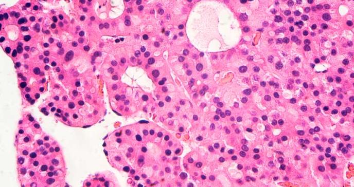 Identifican prometedores compuestos que ‘matan’ el cáncer de hígado