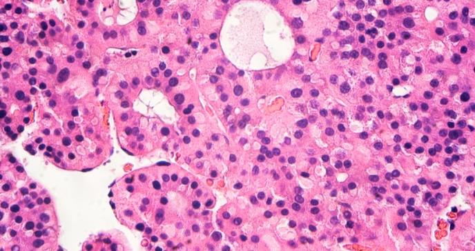 Identifican un mecanismo por el que algunos tumores hepáticos son resistentes a inmunoterapia