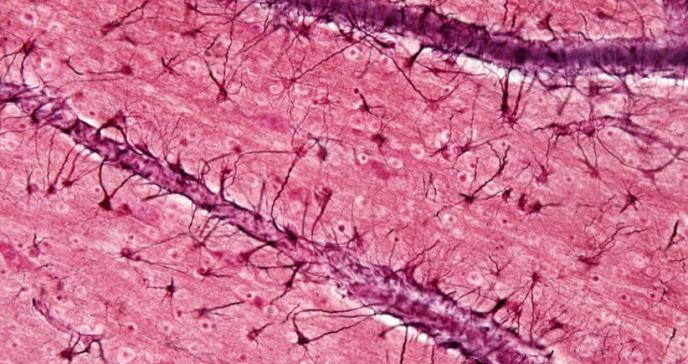 Identifican una nueva diana terapéutica contra el alzhéimer