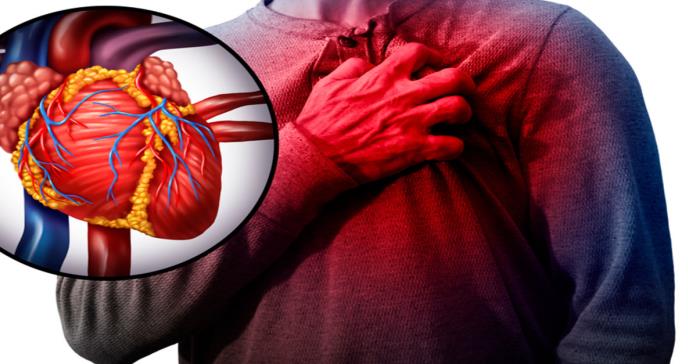 Infarto: condición altamente prevalente pero prevenible