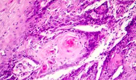 Análisis de sangre menstrual sería eficaz para la detección del VPH, según estudio