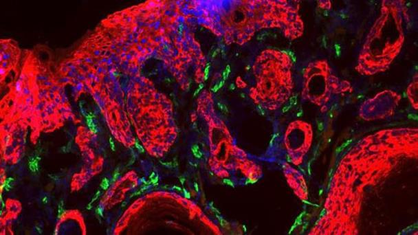 Inmunoterapia del cáncer, los éxitos crecen Inmunoterapia del cáncer, los éxitos crecen