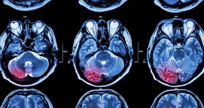La aspirina en dosis bajas está relacionada con sangrado en el cráneo, según nuevo informe