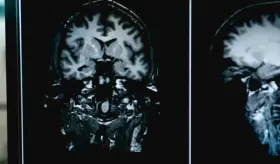 La deficiencia de ácido fólico podría estar relacionada con el alzhéimer