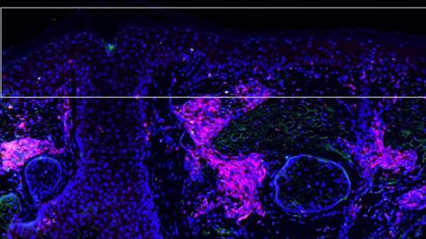 La inmunoterapia ‘en crema’ mantiene a raya el cáncer de piel La inmunoterapia ‘en crema’ mantiene a raya el cáncer de piel