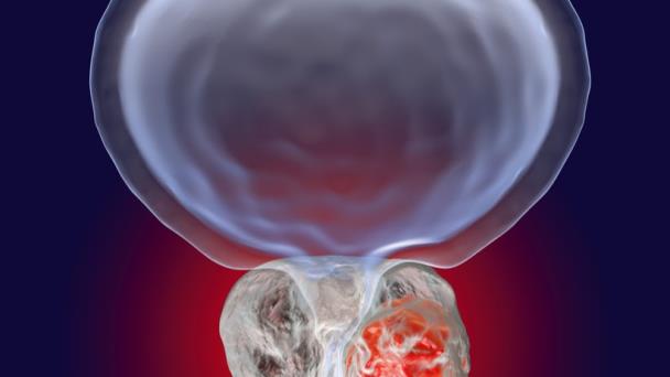 La última generación de antiandrógenos rescata a los pacientes con cáncer de próstata con metástasis La última generación de antiandrógenos rescata a los pacientes con cáncer de próstata con metástasis