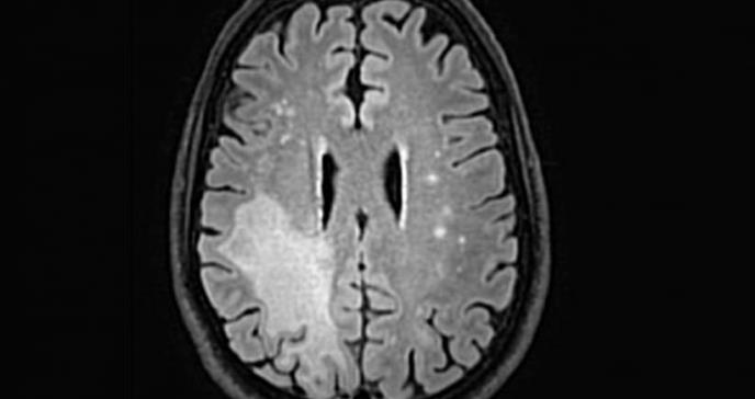 Liberar un freno del sistema inmunológico podría ayudar a los pacientes con una infección cerebral poco frecuente pero mortal