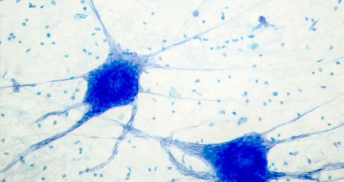 Los pacientes de alzheimer necesitan actividad física
