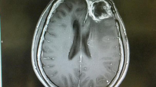 mAb80, un anticuerpo clave para tratar muchos tipos de cáncer mAb80, un anticuerpo clave para tratar muchos tipos de cáncer