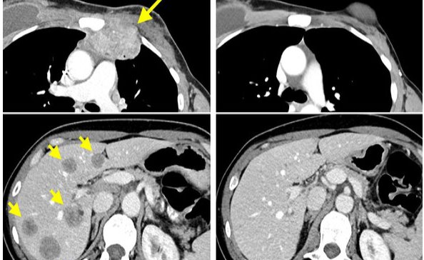 Eliminan el cáncer de mama gracias a las células T de la propia paciente