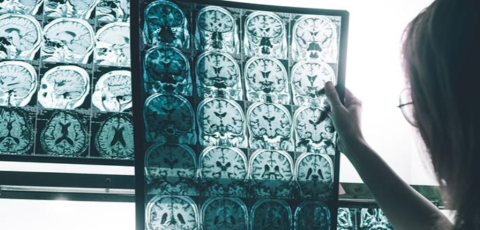 Qué es la mutación Jalisco y su relación con el Alzheimer