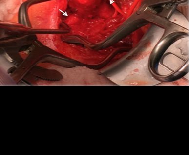 Medicina vascular y endovascular en Puerto Rico logra reparar rara aneurisma