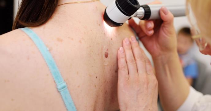 Melanoma cutáneo, el tipo de cáncer de piel más agresivo
