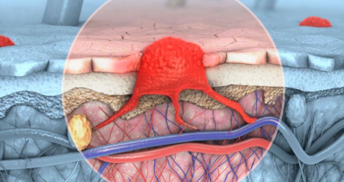Factores implicados en el desarrollo del melanoma maligno