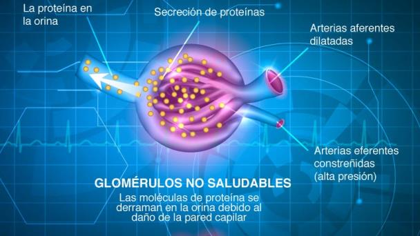 Neuropatía diabética: tipos, síntomas y prevención