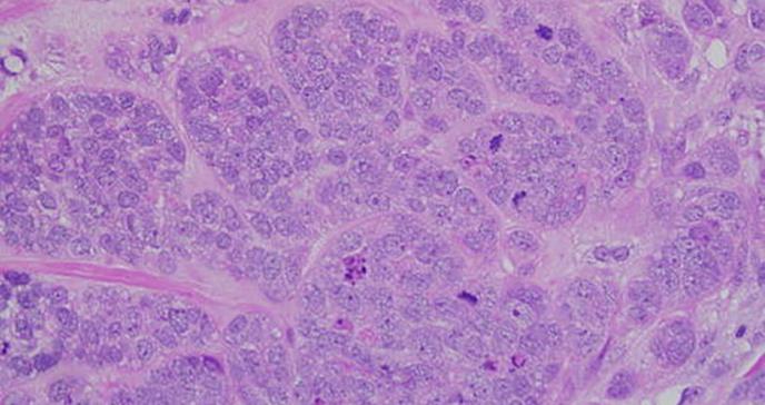 Nanomedicina eficaz contra tumores de mama agresivos