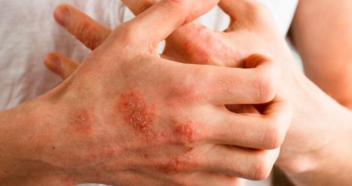 Nuevo paradigma para tratar psoriasis: abordaje multidisciplinar