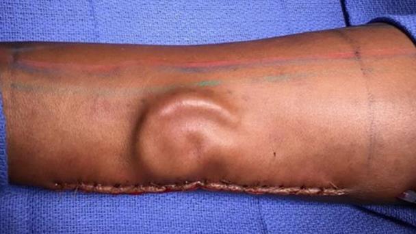 Cirujanos reimplantan oído que creció en el brazo de una paciente Cirujanos reimplantan oído que creció en el brazo de una paciente