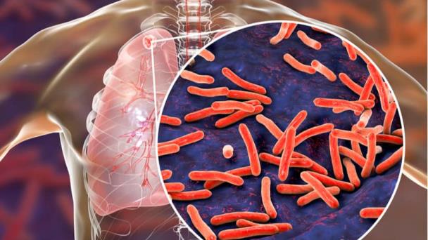 Gran parte de la población mundial tiene riesgo de padecer tuberculosis