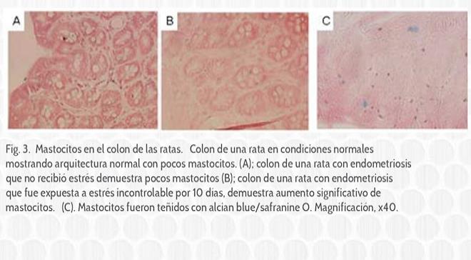 El estrés afecta la progresión, los mecanismos centrales de percepción de dolor y los parámetros inflamatorios de la endometriosis