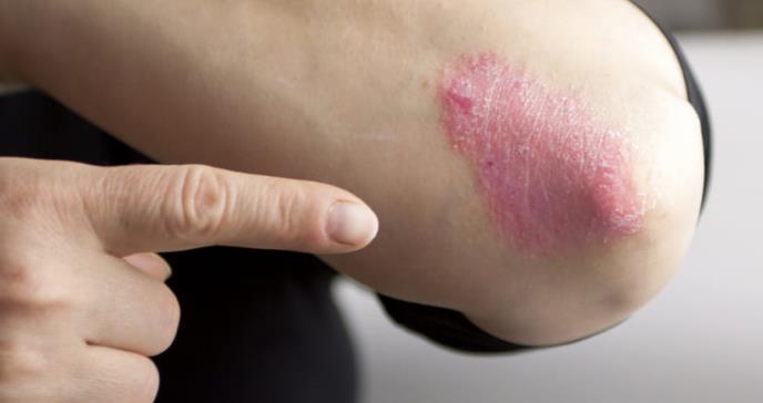 Psoriasis e hígado graso no alcohólico están estrechamente relacionados