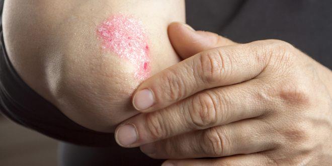 Los pacientes con psoriasis tienen un mayor riesgo de periodontitis crónica