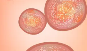 Relacionan la psoriasis con enfermedades card&iacute;acas en puertorrique&ntilde;os