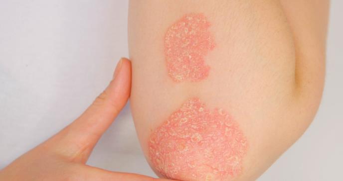 Genética de la psoriasis: una enfermedad con  condiciones multifactoriales