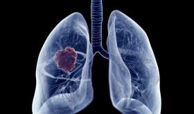 Estadísticas importantes sobre el cáncer de pulmón