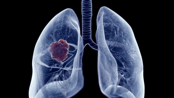 Estadísticas importantes sobre el cáncer de pulmón Estadísticas importantes sobre el cáncer de pulmón