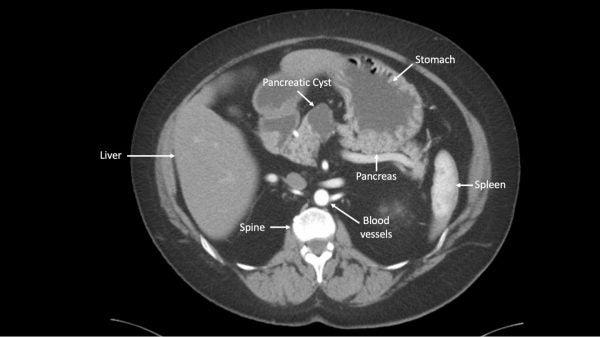 Inteligencia artificial podría determinar qué quistes pancreáticos son cancerígenos