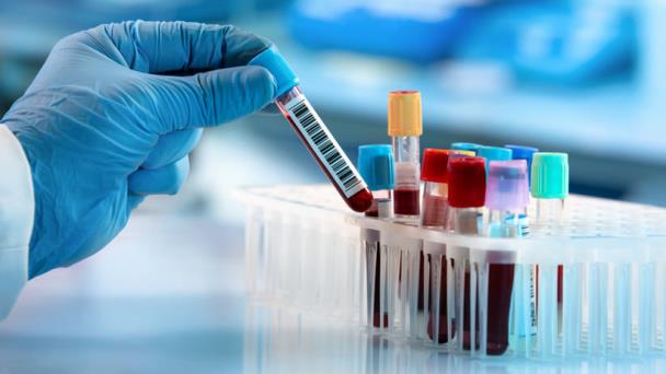 Nuevo test de sangre podría detectar el cáncer de próstata con mayor precisión Nuevo test de sangre podría detectar el cáncer de próstata con mayor precisión