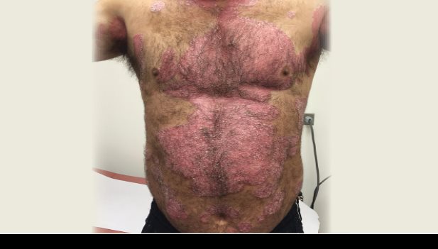 Psoriasis, más allá de la piel del paciente