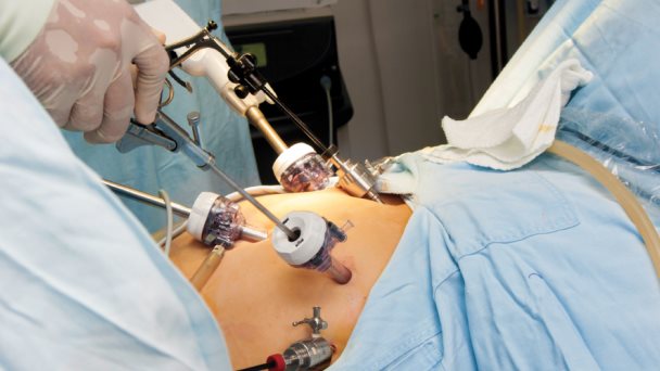 Los efectos metabólicos de la cirugía bariátrica en pacientes puertorriqueños Los efectos metabólicos de la cirugía bariátrica en pacientes puertorriqueños