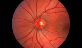 Científicos logran restaurar la visión de modelos con lesión del nervio óptico con coctel farmacológico