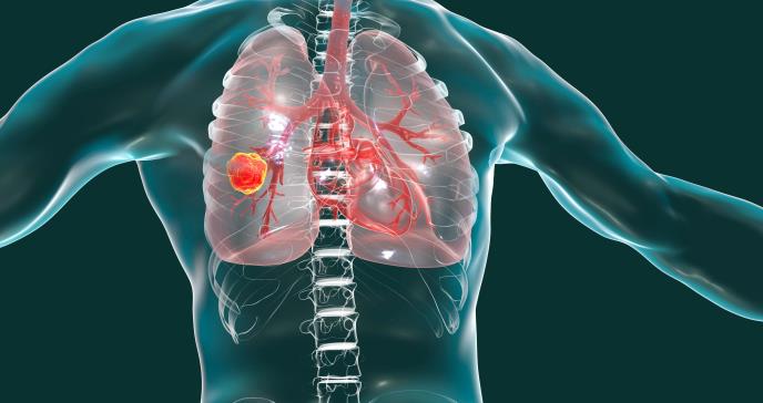 Hallan feroz cáncer de pulmón que no tendría relación con el tabaquismo
