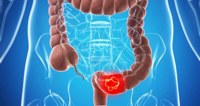 Estudio revela aumento de cáncer de colon en latinos y afroamericanos en EE. UU.