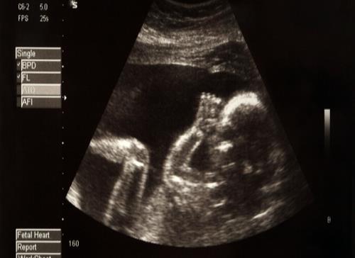 La tasa de mortalidad materna en Puerto Rico desciende significativamente gracias al cuidado prenatal
