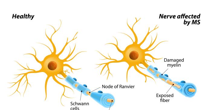 Niveles de vitamina D en sangre ayudan a predecir el riesgo de esclerosis múltiple