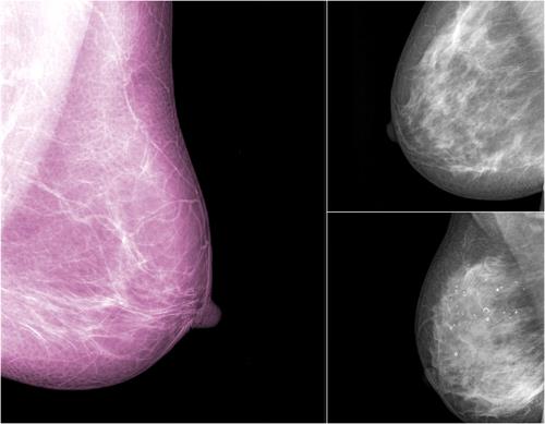 Aprobado un nuevo tratamiento para reducir recurrencia del cáncer de seno Aprobado un nuevo tratamiento para reducir recurrencia del cáncer de seno