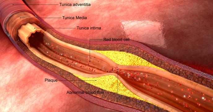 Hallan una nueva molécula eficaz contra la aterosclerosis y la miocarditis