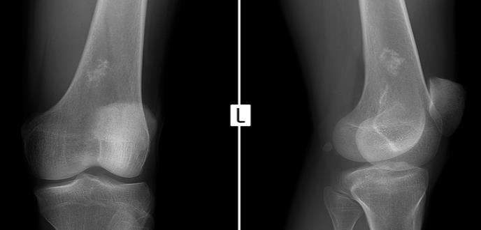 Investigadores prueban con éxito una nueva terapia combinada en sarcomas