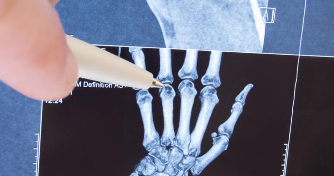 Aprobada cuarta indicación de XELJANZ® para el tratamiento de la artritis idiopática juvenil