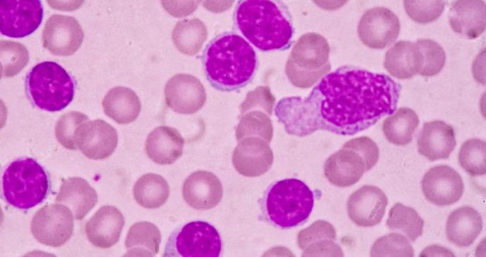 Descifran cómo funciona el genoma de la leucemia