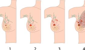 Positivo el Pembrolizumab más la quimioterapia en pacientes con cáncer de mama metastásico triple negativo