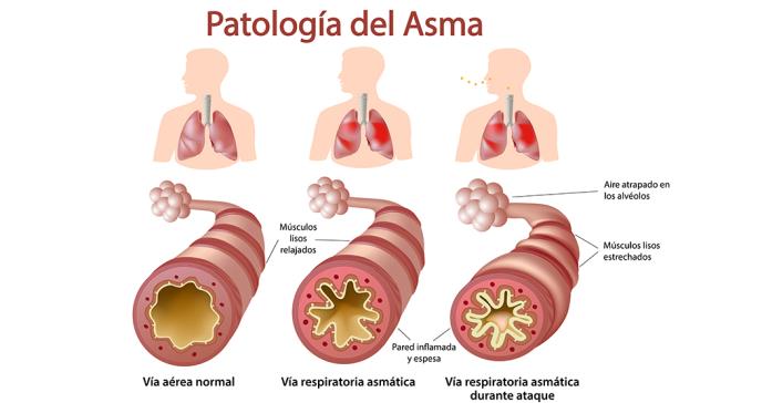Encuesta señala que pacientes con asma descontrolada piensan equivocadamente que su condición está bajo control