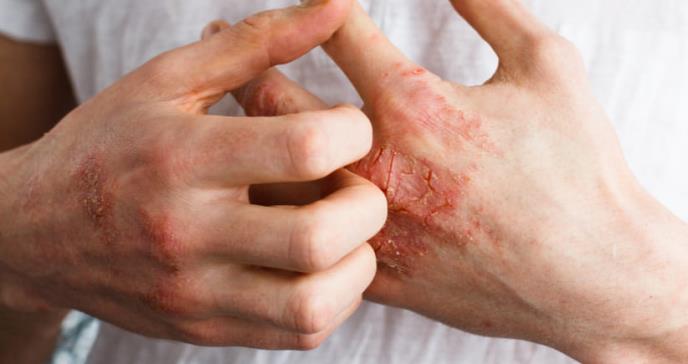 Si tienes psoriasis, sufres más riesgo de estas tres enfermedades