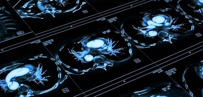 Juntos contra el cáncer de pulmón
