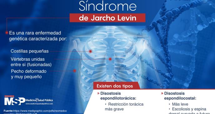 Síndrome de Jarcho Levin